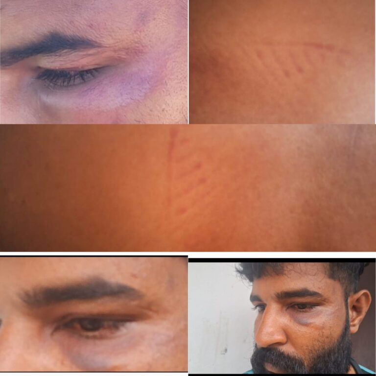 “പോലീസ് മർദ്ദിച്ചതായി പരാതി യുവാവ് ആശുപത്രി യിൽ ചികിൽസ തേടി”